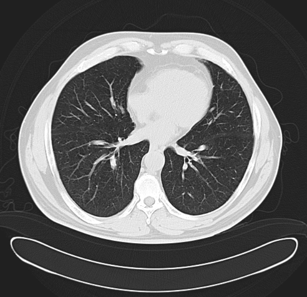 Centrilobular pulmonary emphysema (Radiopaedia 26808-26971 C 28).jpg