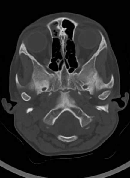 Cerebellar abscess (Radiopaedia 73727-84527 Axial bone window 20).jpg