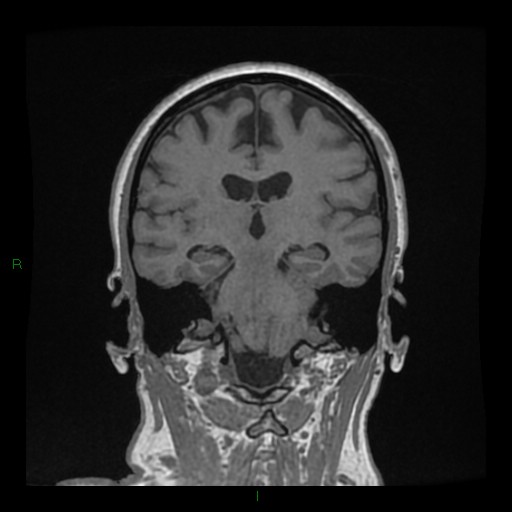 File:Cerebellar abscess (Radiopaedia 78135-90678 Coronal T1 C+ 94).jpg