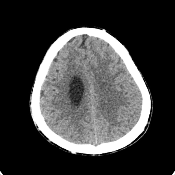 Cerebellar abscess secondary to mastoiditis (Radiopaedia 26284-26412 Axial non-contrast 122).jpg