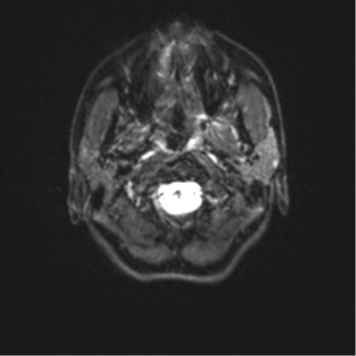 Cerebellar agenesis with hypoplastic pons (pontocerebellar hypoplasia) (Radiopaedia 57224-64138 Axial DWI 3).png