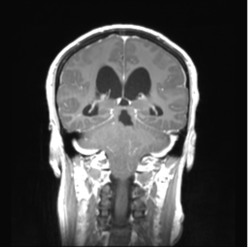 Cerebellar ependymoma complicated by post-operative subdural hematoma (Radiopaedia 83322-97736 Coronal T1 C+ 35).png