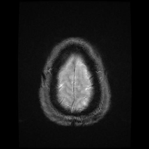 File:Cerebellar hemangioblastoma (Radiopaedia 88055-104622 Axial Gradient Echo 19).jpg