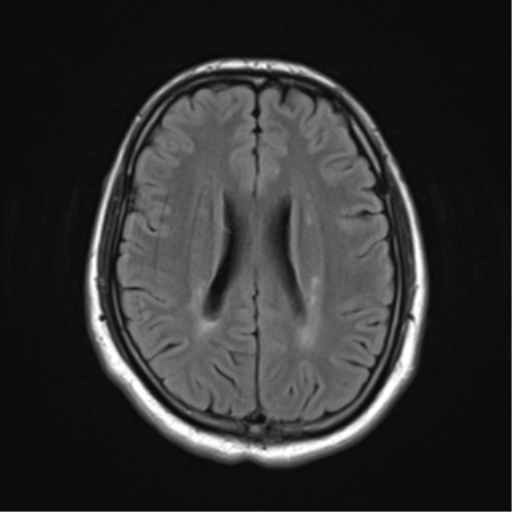 File:Cerebellar hemangioblastomas and pituitary adenoma (Radiopaedia 85490-101176 Axial FLAIR 19).png