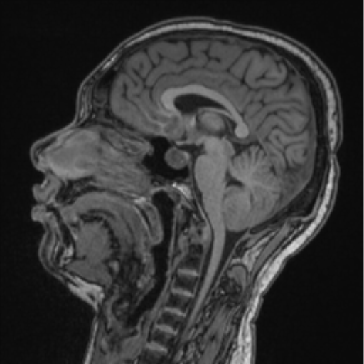 File:Cerebellar hemangioblastomas and pituitary adenoma (Radiopaedia 85490-101176 Sagittal T1 54).png
