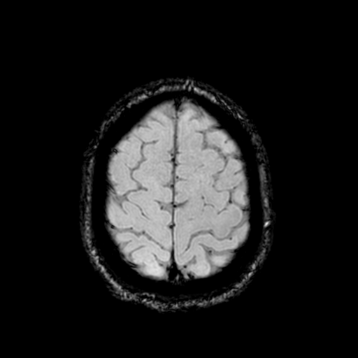 Cerebellar hemorrhage (Radiopaedia 37000-38666 Axial Gradient Echo 69).png