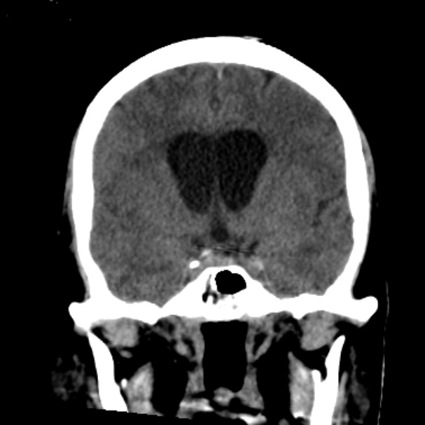 Cerebellar hemorrhage causing obstructive hydrocephalus (Radiopaedia 33989-35207 Coronal non-contrast 24).jpg