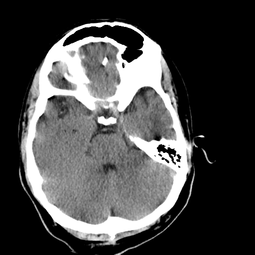 File:Cerebellar infarct due to vertebral artery dissection with posterior fossa decompression (Radiopaedia 82779-97029 Axial non-contrast 8).png