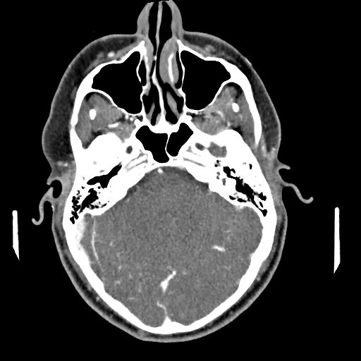 Cerebellar infarct due to vertebral artery dissection with posterior fossa decompression (Radiopaedia 82779-97029 C 14).png