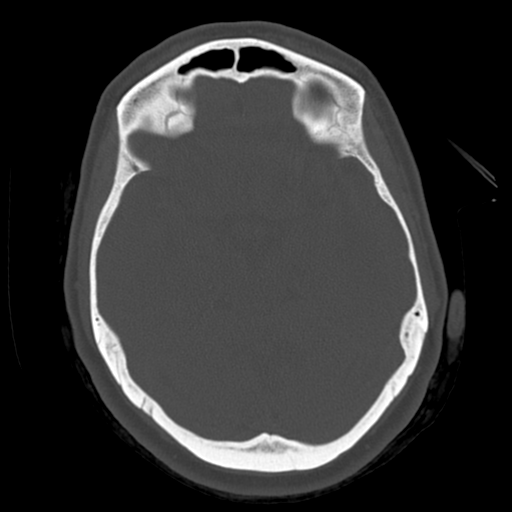 File:Cerebellar metastasis (cystic appearance) (Radiopaedia 41395-44258 Axial bone window 25).png