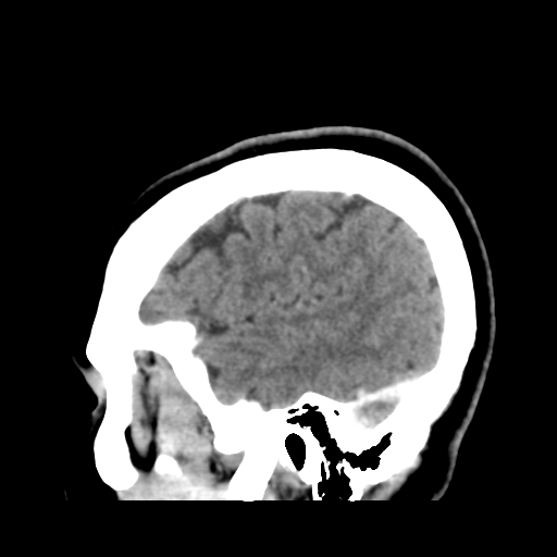 File:Cerebellar metastasis (cystic appearance) (Radiopaedia 41395-44258 F 43).png