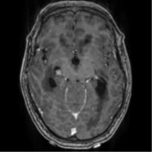 File:Cerebellar metastasis from lung adenocarcinoma (Radiopaedia 86690-102829 Axial T1 C+ 36).png