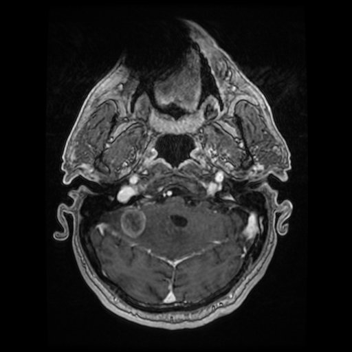 Cerebellar metastasis of pulmonary adenocarcinoma, cavernous venous malformation, and developmental venous anomaly (Radiopaedia 85827-101661 Axial T1 C+ 28).jpg