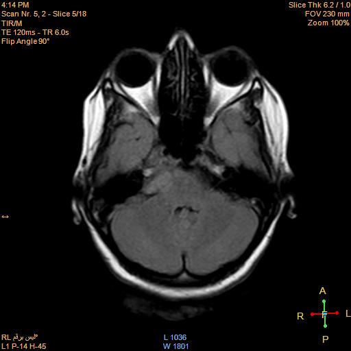 File:Cerebellopontine angle meningioma (Radiopaedia 22488-22525 Axial FLAIR 3).jpg