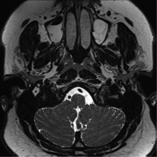 Cerebellopontine angle meningioma (Radiopaedia 48434-53348 Axial T2 Space 16).png