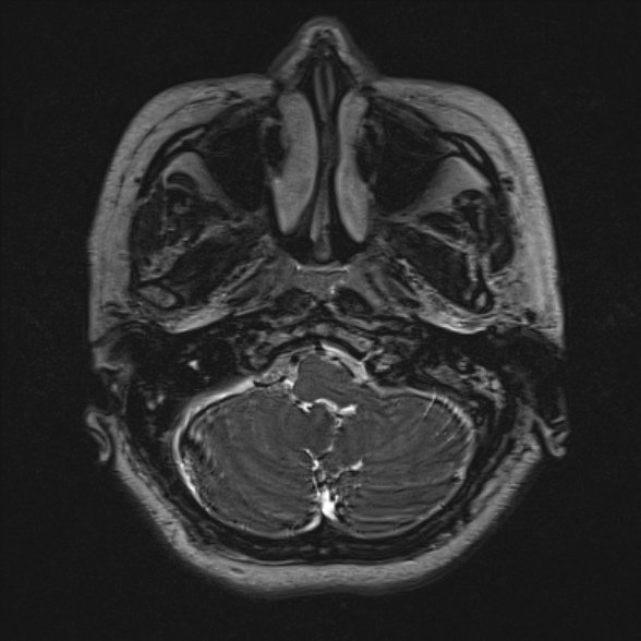 File:Cerebellopontine angle meningioma (Radiopaedia 53561-59591 Axial 3D volume T2 30).jpg