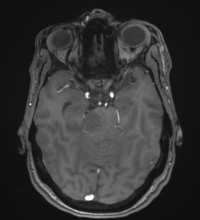 Cerebellopontine angle meningioma (Radiopaedia 72983-83680 Axial MRA 45).jpg