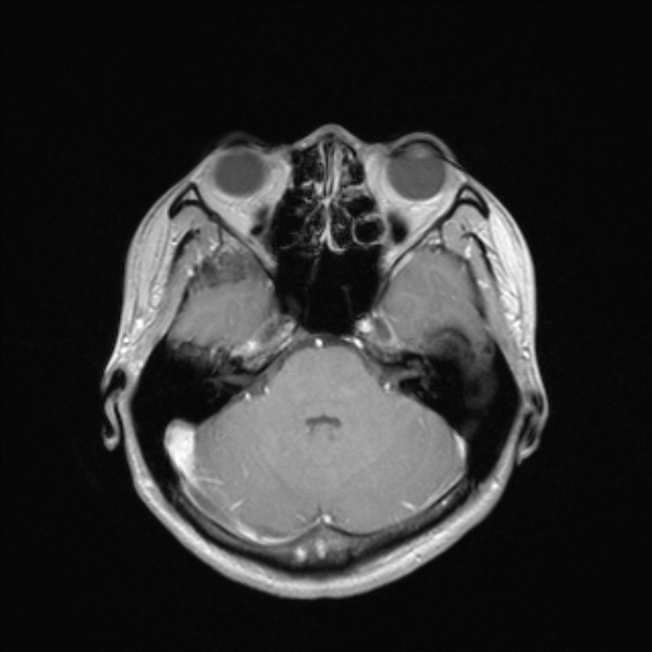 Cerebral abscess (Radiopaedia 24212-24478 Axial T1 C+ 21).jpg