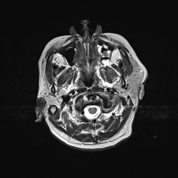 Cerebral abscess (Radiopaedia 26111-26247 Axial T2 8).jpg