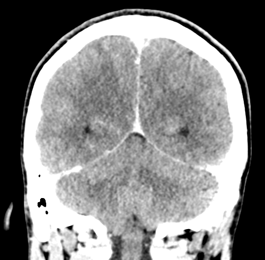 Cerebral abscess (Radiopaedia 60342-68008 Coronal C+ delayed 48).png