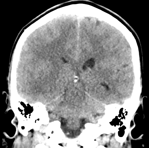 Cerebral abscess (Radiopaedia 60342-68008 Coronal non-contrast 39).png