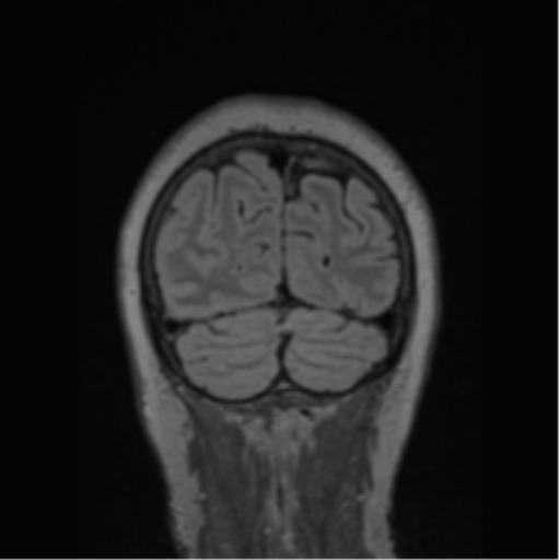 Cerebral abscess from pulmonary arteriovenous malformation (Radiopaedia 86275-102291 Coronal FLAIR 18).png