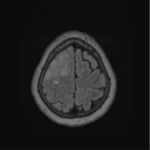 Cerebral abscess from pulmonary arteriovenous malformation (Radiopaedia 86275-102291 J 64).png