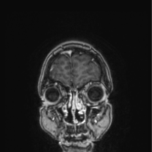 Cerebral abscess from pulmonary arteriovenous malformation (Radiopaedia 86275-102291 L 80).png