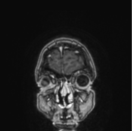 Cerebral abscess from pulmonary arteriovenous malformation (Radiopaedia 86275-102291 L 82).png