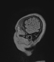 Cerebral abscess from pulmonary arteriovenous malformation (Radiopaedia 86275-102291 Sagittal FLAIR 9).png