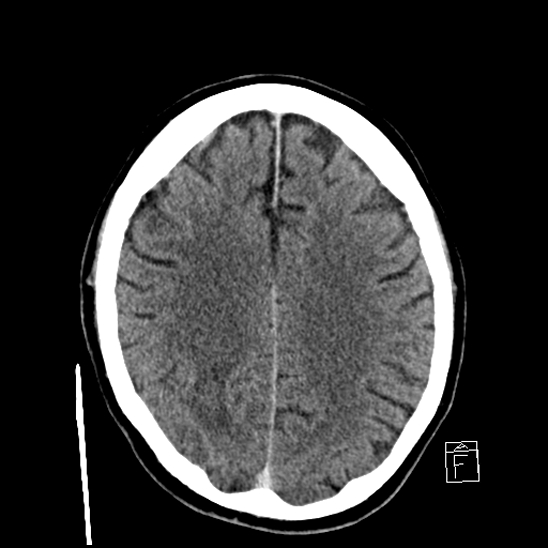 File:Cerebral abscess with ventriculitis (Radiopaedia 78965-91877 A 32).jpg