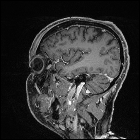 Cerebral abscess with ventriculitis (Radiopaedia 78965-91878 Sagittal T1 C+ 50).jpg