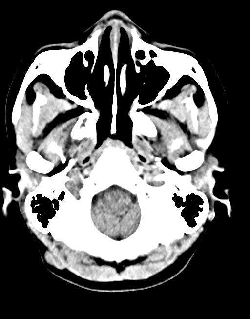 Cerebral abscesses (Radiopaedia 70458-80568 Axial non-contrast 13).jpg
