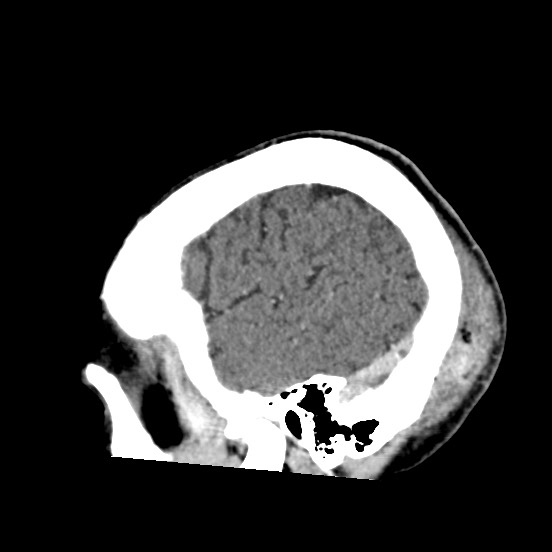 Cerebral amyloid angiopathy-related inflammation (Radiopaedia 74836-85848 C 51).jpg