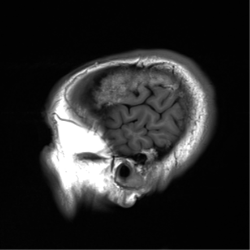 File:Cerebral amyloid angiopathy (Radiopaedia 46082-50433 Sagittal T1 2).png