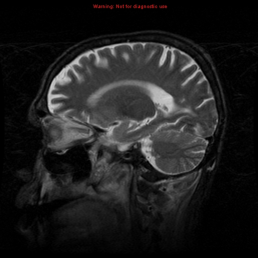 File:Cerebral and orbital tuberculomas (Radiopaedia 13308-13311 Sagittal T2 13).jpg