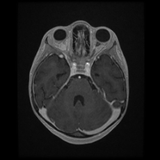 Cerebral and spinal tuberculosis (Radiopaedia 90489-107837 Axial T1 C+ 70).jpg