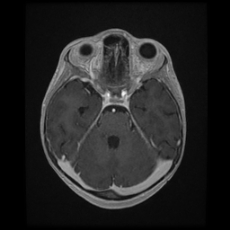 Cerebral and spinal tuberculosis (Radiopaedia 90489-107837 Axial T1 C+ 73).jpg