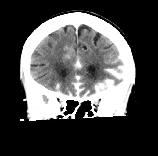 File:Cerebral aneurysm with rupture (Radiopaedia 29933-30460 Coronal non-contrast 11).jpg