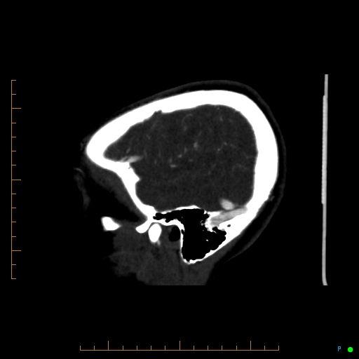File:Cerebral arteriovenous malformation (AVM) (Radiopaedia 78162-90706 Sagittal CTA 14).jpg