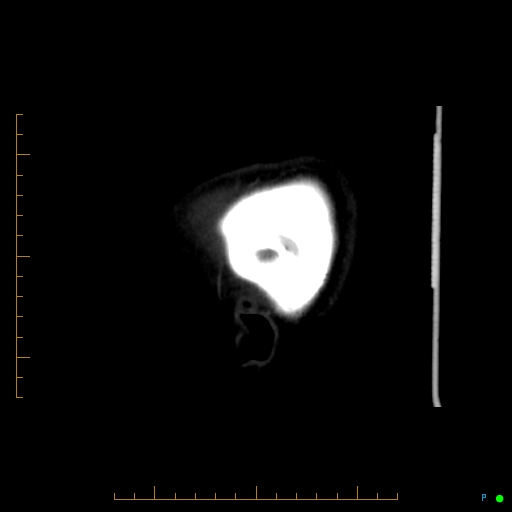 File:Cerebral arteriovenous malformation (AVM) (Radiopaedia 78162-90706 Sagittal CTA 7).jpg