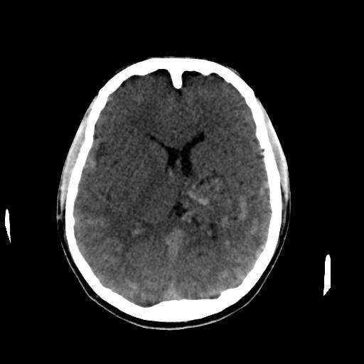 Cerebral arteriovenous malformation (Radiopaedia 28518-28759 Axial non-contrast 39).jpg