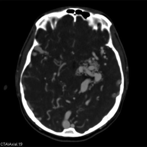 Cerebral arteriovenous malformation (Radiopaedia 28518-28759 B 19).jpg