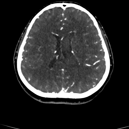 Cerebral arteriovenous malformation (Radiopaedia 73830-84645 Axial C+ delayed 36).jpg