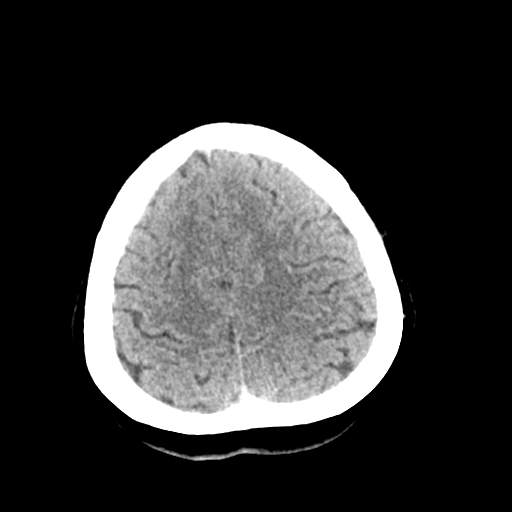 File:Cerebral arteriovenous malformation (Radiopaedia 73830-84645 Axial non-contrast 38).jpg
