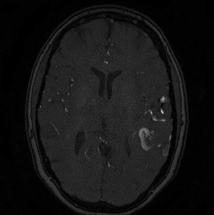 Cerebral arteriovenous malformation (Radiopaedia 74411-85654 Axial MRA 81).jpg
