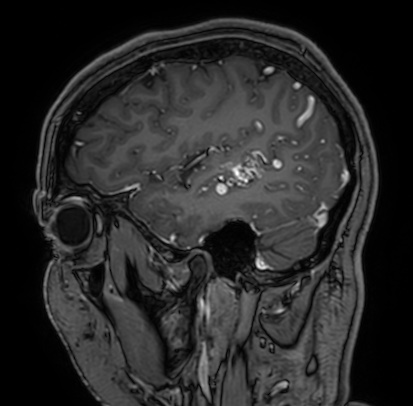 Cerebral arteriovenous malformation (Radiopaedia 74411-85654 Sagittal T1 C+ 24).jpg