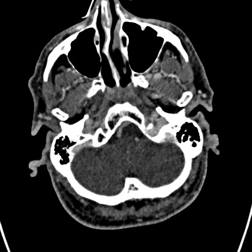 Cerebral arteriovenous malformation (Radiopaedia 78188-90746 Axial C+ delayed 25).jpg