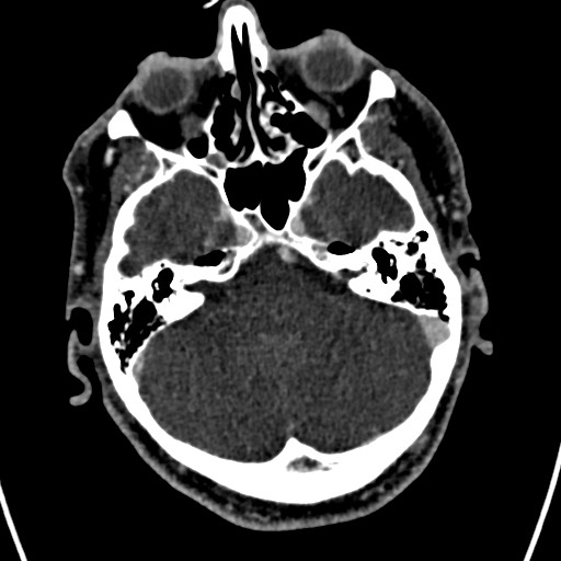 Cerebral arteriovenous malformation (Radiopaedia 78188-90746 Axial C+ delayed 43).jpg