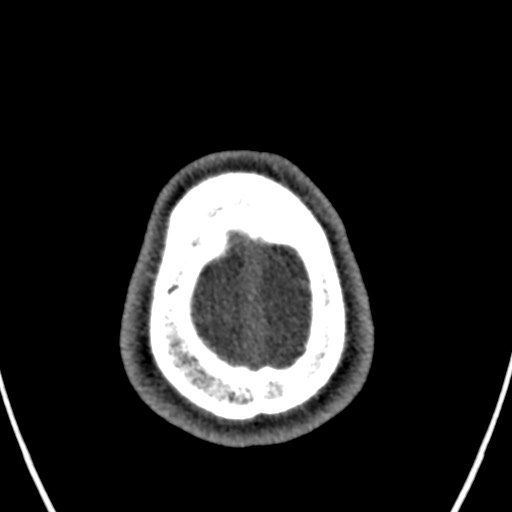 File:Cerebral arteriovenous malformation (Radiopaedia 78188-90746 Axial non-contrast 170).jpg